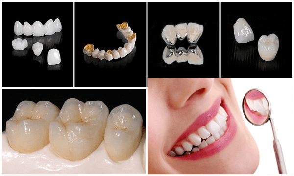 bọc răng sứ là gì, bọc răng sứ có tốt không, bọc răng sứ có bền không, bọc răng sứ như thế nào, bọc răng sứ có ảnh hưởng gì không, bọc răng sứ thẩm mỹ có tốt không, bọc răng sứ thẩm mỹ có ảnh hưởng gì không