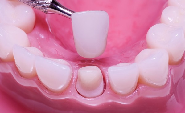 Bọc răng sứ có tốt không? Lời giải đáp từ chuyên gia  nha khoa